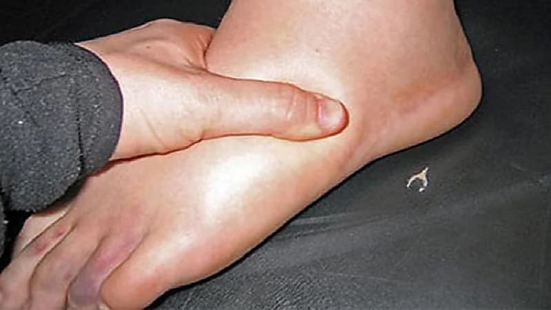 أعراض الإصابة بمرض ساق المدخن