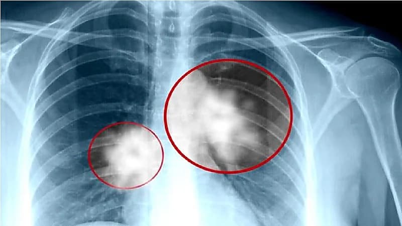 بالفيديو .. رحلة علاج مواطن اكتشف إصابته بالسرطان في يوم زفاف ابنته