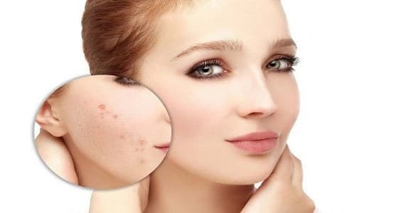 قناع بسيط يخلصك من حب الشباب