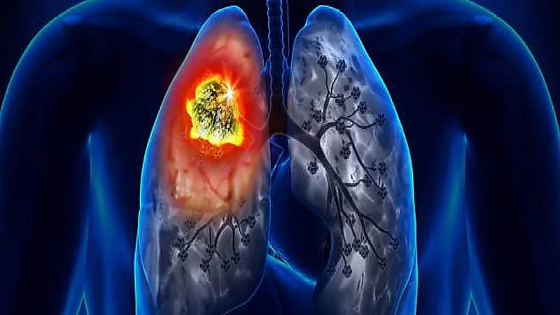 7 نصائح لا تتجاهلها للوقاية من سرطان الرئة