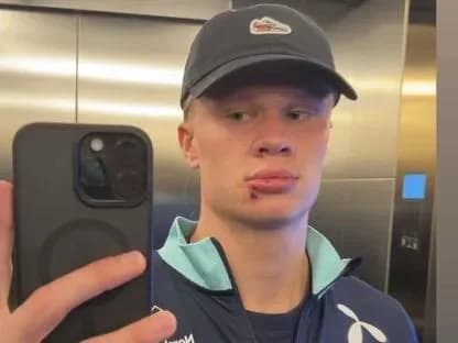 هالاند يتعرض لإصابة في وجهه بعد اصطدامه في باب حافلة