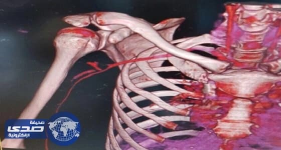 عملية ناجحة لإنقاذ مصاب بمستشفى الملك خالد العام بحفر الباطن