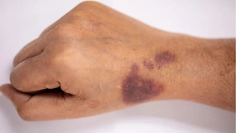 تعرف على مرض الهيموفيليا الذي ظهر في مسلسل بطلوع الروح