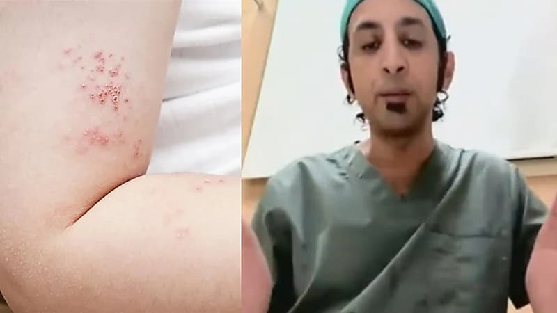 استشاري: النساء أكثر عرضة للإصابة بـ "الحزام الناري"