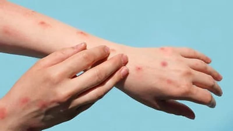 لماذا لم يتحول جدري القردة إلى وباء مثل كورونا ؟ نزار باهبري يكشف .. فيديو