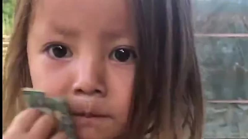 طفلة تايلاندية ينمو شعر على ذراعها كما فروة الرأس ..فيديو