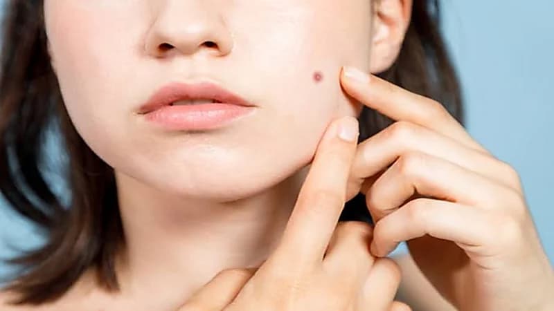 مختص: بعض الشامات يمكن أن تكون قاتلة