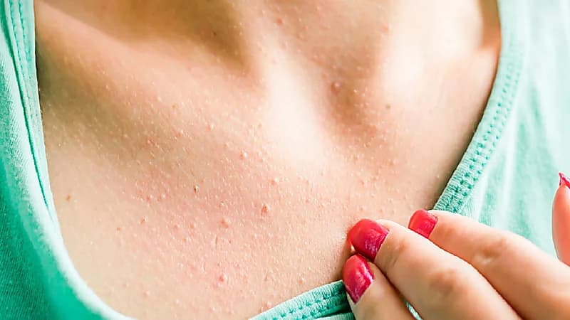 خطوات بسيطة وفعالة للتخلص من حبوب الصدر المزعجة