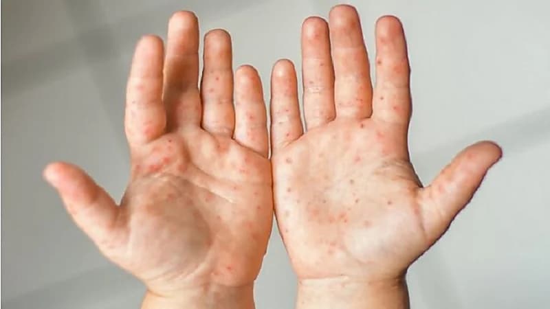 إغلاق عشرات من رياض الأطفال بسبب انتشار مرض جلدي مُعدٍ في ماليزيا