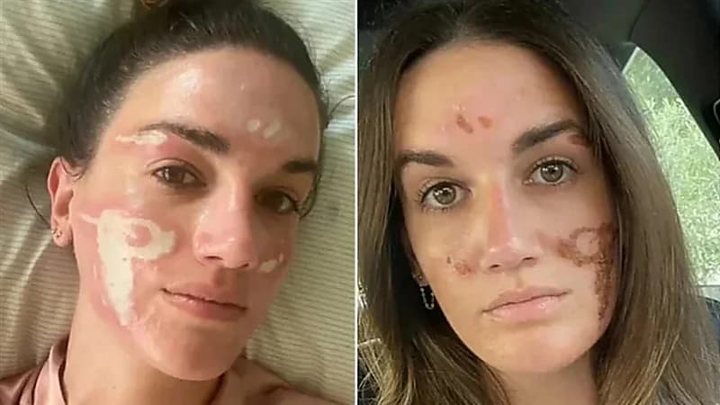 خبيرة تجميل شهيرة تتسبب في تشويه وجه فتاة أثناء علاج حب الشباب