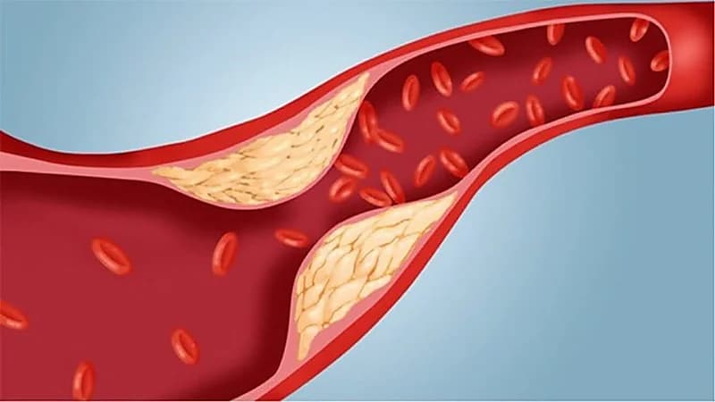 الذيابي يوجه نصيحة للمصابين بارتفاع دهون الدم
