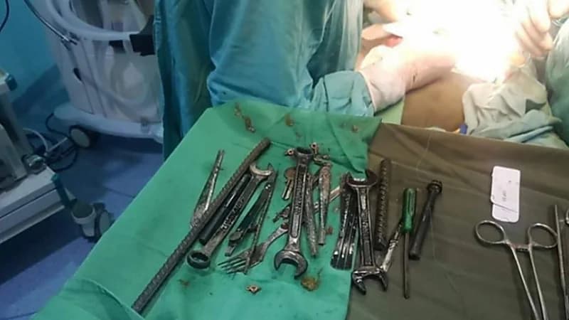 استخراج مفاتيح ومسامير من بطن مريض للمرة الرابعة على التوالي