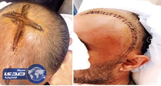 إصابة مواطن بنزيف إثر معالجته بالكي بطريقة خاطئة