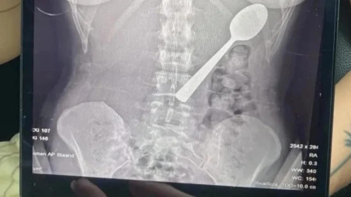 امرأة تبتلع ملعقة عن طريق الخطأ