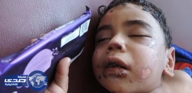 مصري يٌعذب طفل زوجته بالكي بالنار