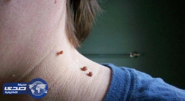 وصفات طبيعية لتتخلّصي من الشامات المزعجة والثآليل