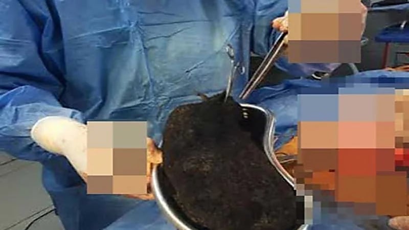 أطباء يستخرجون 3 كيلو شعر من معدة شاب