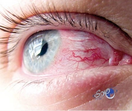 "الرمد الربيعي".. أحد مظاهر الدفاع عن النفس