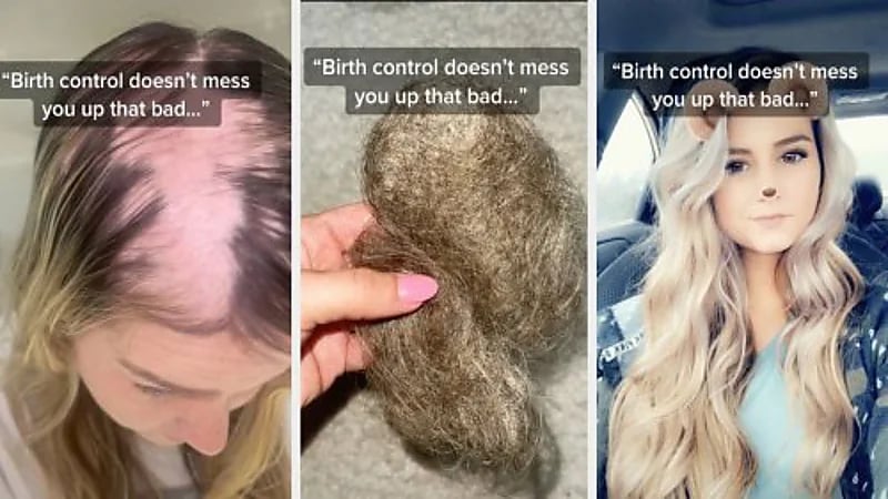 فتاة تفقد شعرها وتصاب بالصلع بسبب حبوب منع الحمل