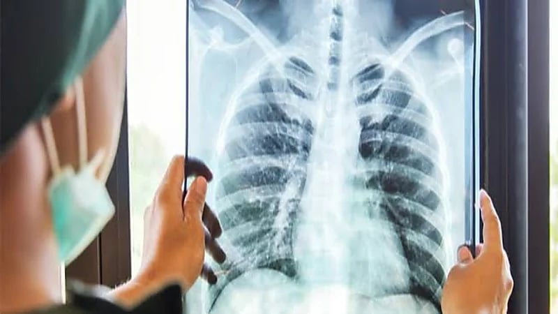 أعراض الدرن وطرق الوقاية منه