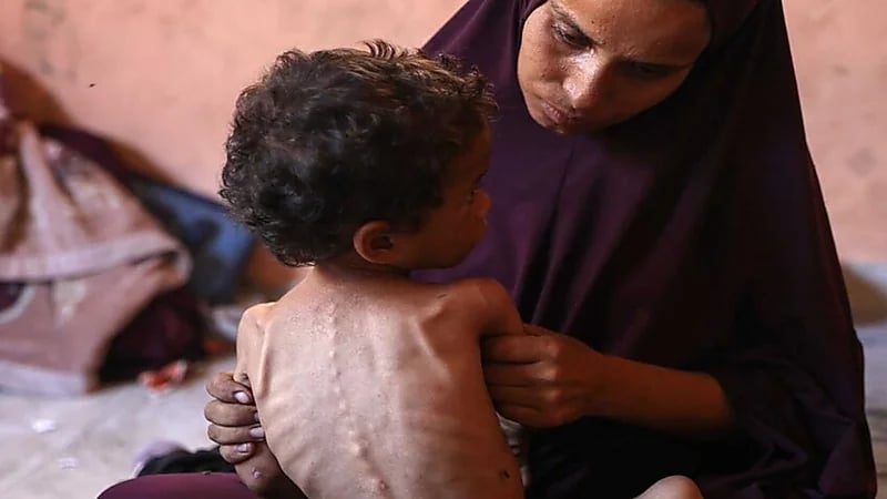 فيروس قاتل يشبه كورونا يهدد حياة الأطفال الجوعى في غزة