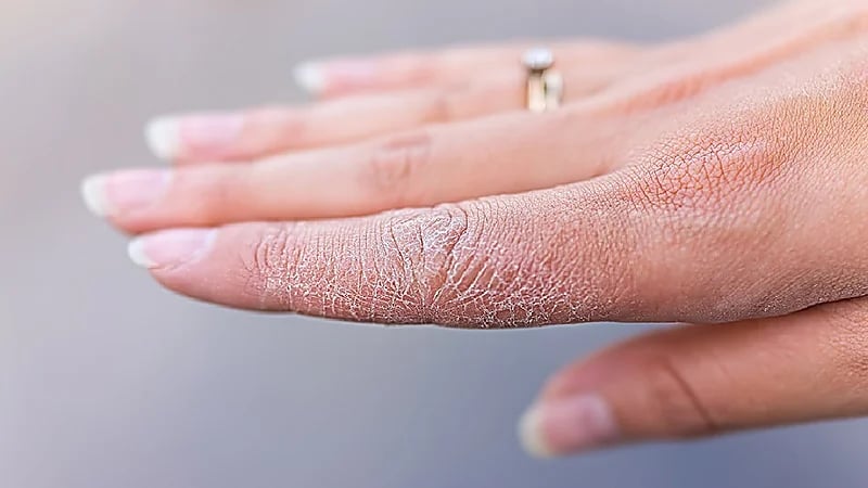 بالفيديو .. علامات تنذر بنقص الزنك في الجسم