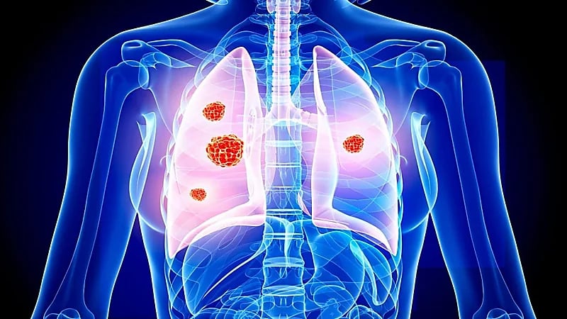 أعراض تشير إلى الإصابة بسرطان الرئة
