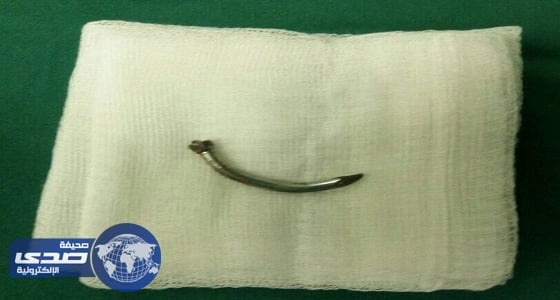 استخراج مسمار من عين مصاب بالمستشفى السعودي الألماني بعسير