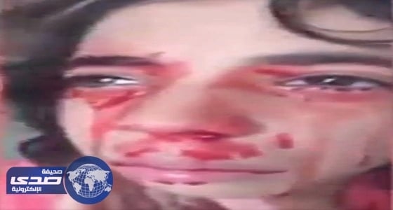 بالفيديو.. " آية " طفلة تنزف دما من كل جسدها