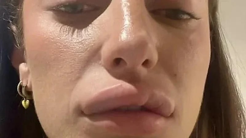 فتاة تشارك تجربتها المؤلمة مع إذابة الفيلر.. صور