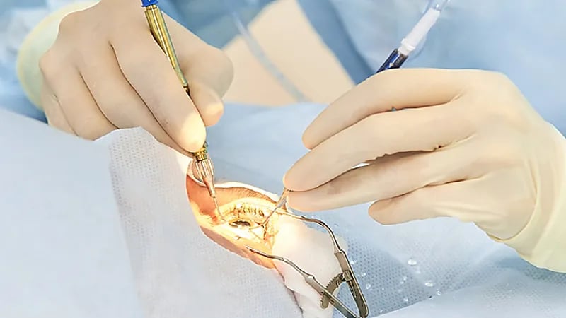 5 علامات تستدعي من الخاضعين لعملية زراعة القرنية الذهاب للطبيب فورا