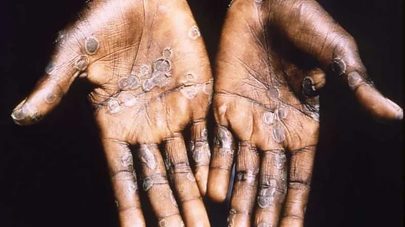 الصحة الإماراتية: رصد أول إصابة بجدري القردة لزائرة من غرب أفريقيا