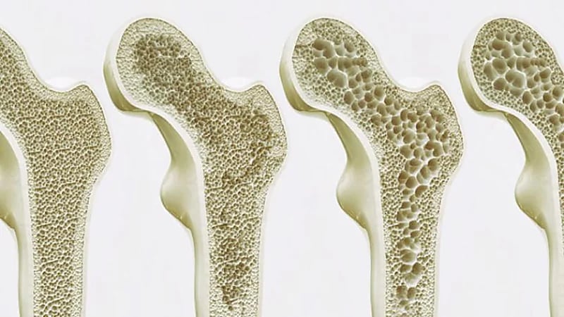 تلوث الهواء يسرع هشاشة العظام وإصابات العمود الفقري