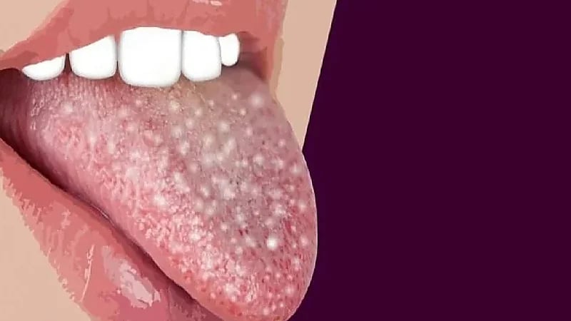 أسباب شائعة تؤدي للمعاناة من حبوب اللسان