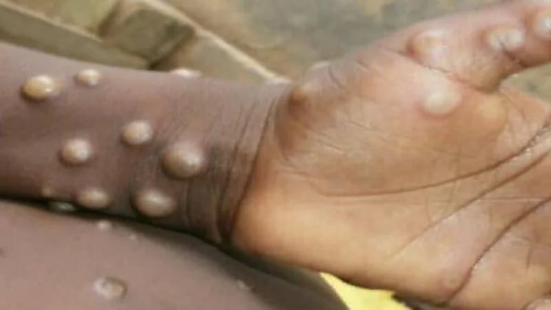 انتشار جدري القردة في كافة الولايات الأمريكية