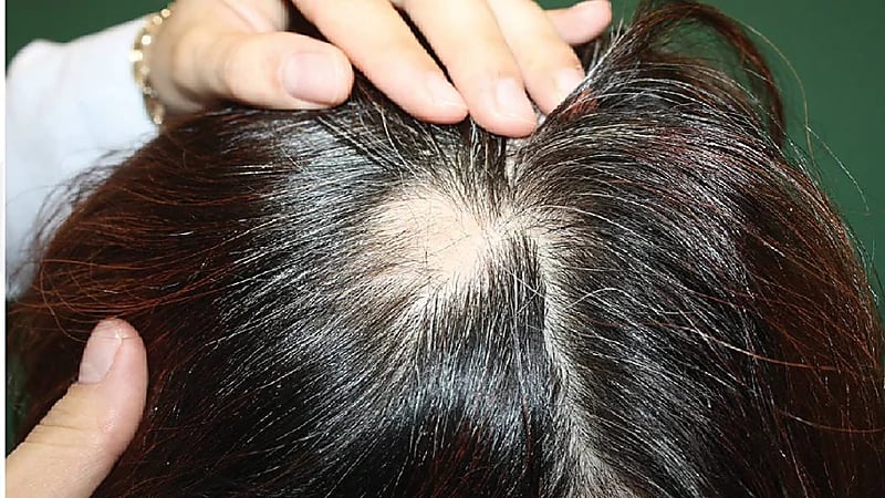 استشاري: احذروا استخدام الثوم في علاج الثعلبة .. فيديو