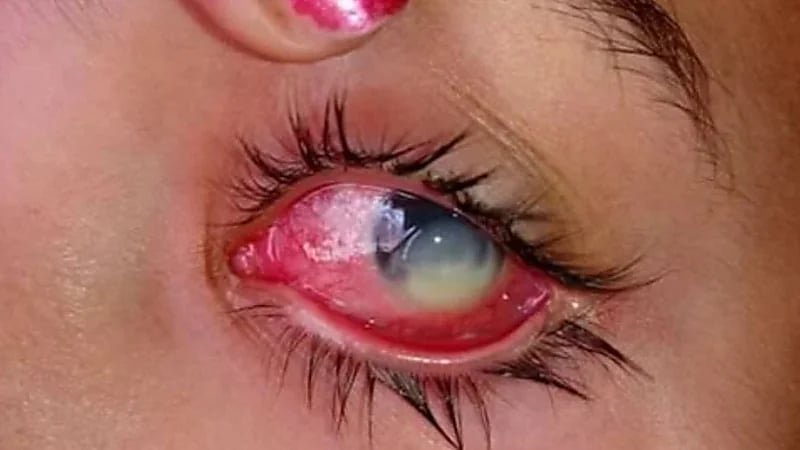 مختص يكشف أضرار ارتداء العدسات اللاصقة في الصيف