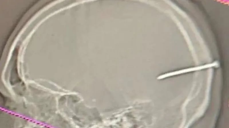 بطول 8 سم .. استخراج "مسمار" من جمجمة مقيم بمستشفى ينبع