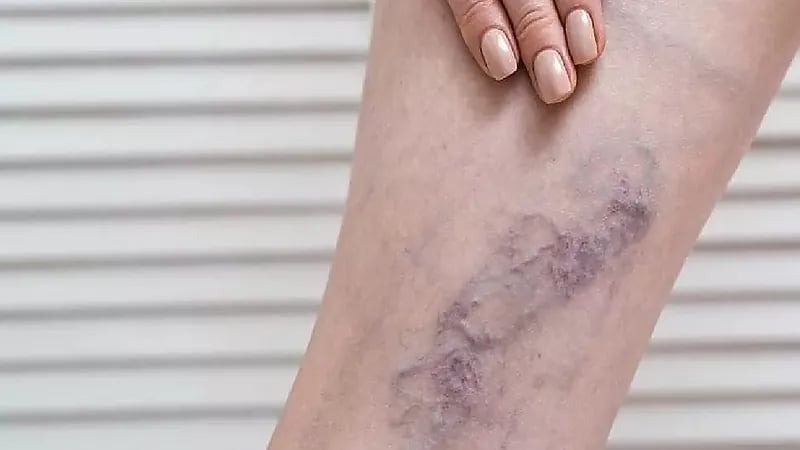 3 أعراض تنذر بالإصابة بالجلطات الوريدية .. فيديو