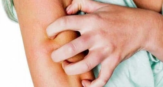 استطلاع: المواطنون يحملون وزارتي الصحة والتعليم مسؤولية انتشار الجرب