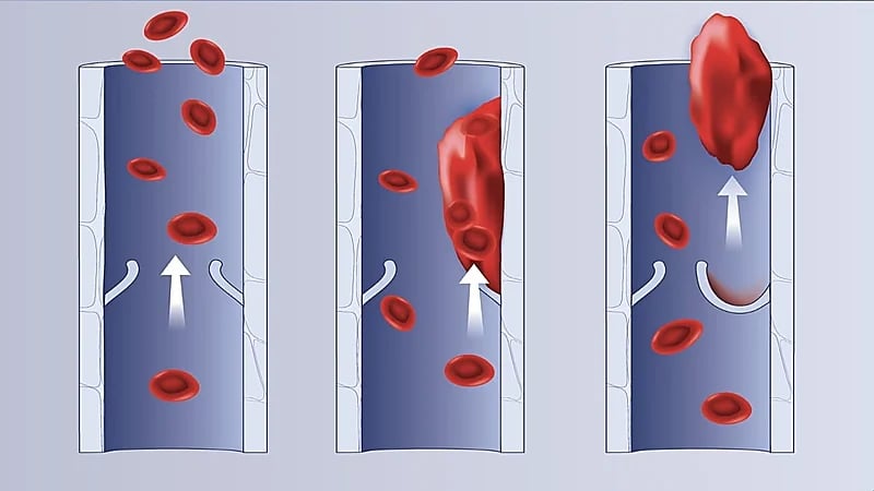 المجلس الصحي السعودي يوضح إحدى طرق الوقاية من الجلطات الوريدية