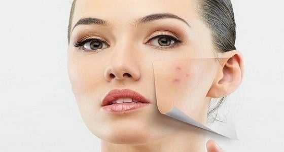 حاربي البثور الهرمونية بهذه الطرق