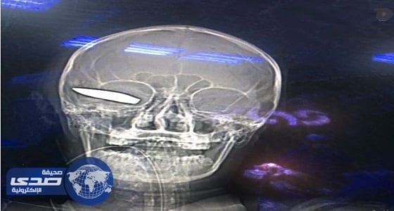 فريق طبي بجازان يستخرج طلقة من رأس أحد جنود التحالف العربي