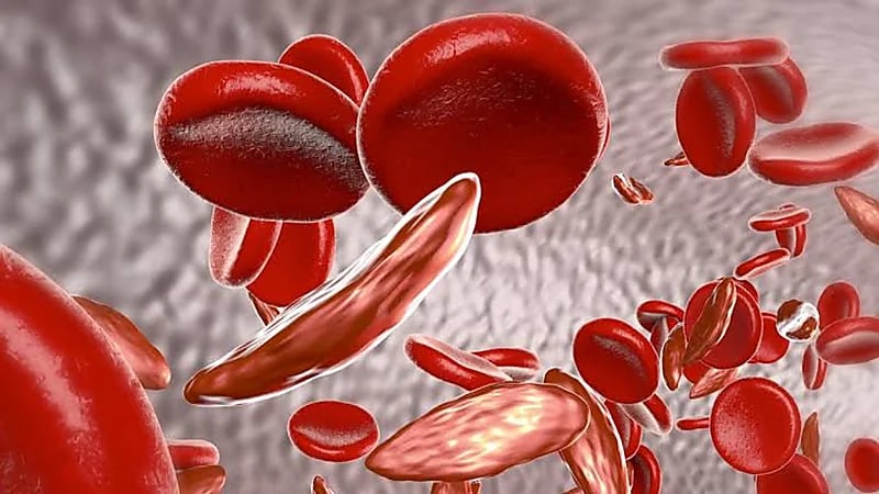أعراض الأنيميا المنجلية وطرق الوقاية منها