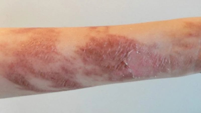 الأقراص المهدئة تتسبب في حرق جلد فتاة ودخولها في غيبوبة