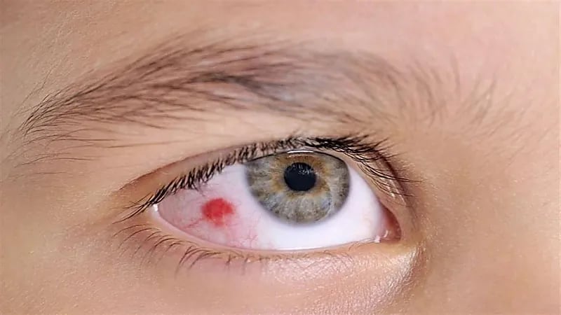 البقع الحمراء في العين تنذر بارتفاع ضغط الدم