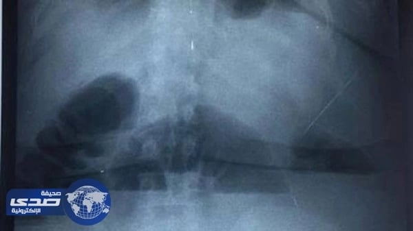 عراقية تتناول المناديل الورقية يومياً لخفض وزنها