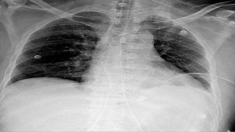 ‏ "سعود الطبية" تنقذ مقيمًا تعرض للإصابة في القلب