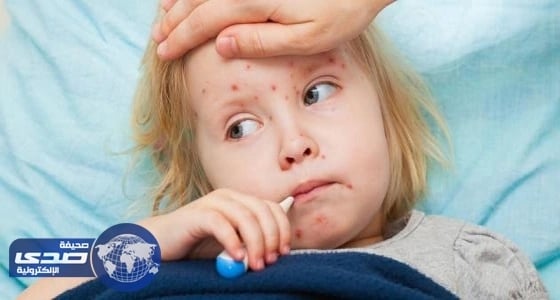 فرنسا على أعتاب التعرض لوباء الحصبة
