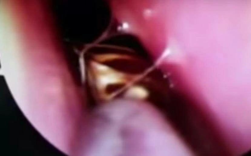 بالفيديو .. اخراج صرصور حي يزحف بجمجمة امرأة هندية